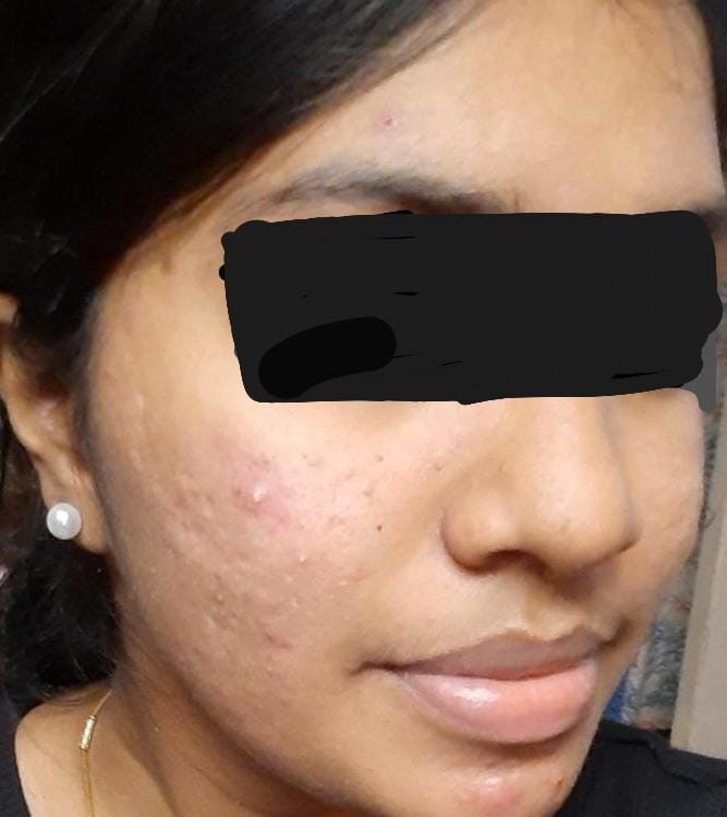 Acne Vulgaris 6